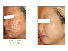 ベルメイク(BELLE MAKE)/ビフォーアフター