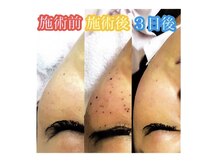 サロン マレ(salon mare)の雰囲気（新メニュー♪ 特殊な低周波機器を使用してシミを改善！！！）
