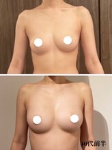 リール 新宿店(RIRE)/ 40代前半　バストアップ症例