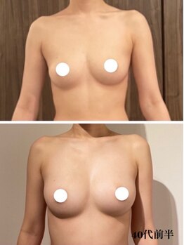 リール 新宿店(RIRE)/ 40代前半 バストアップ症例