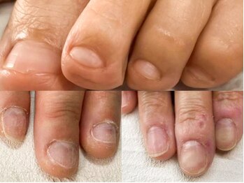 ポメロ(POMELO)/深爪、皮膚むしりも大丈夫