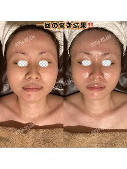 アユスリム(AYU SLIM)/一回でも変化できるの充実小顔
