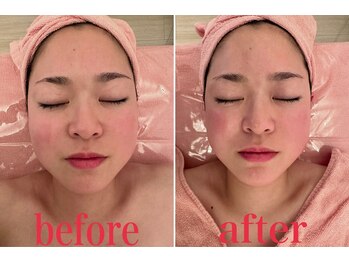 小顔矯正 アメリ ビューティーサロン(Ameri beauty salon)/韓国式コルギ小顔コース