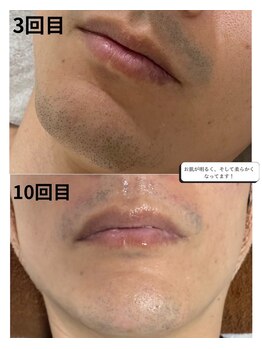 シロ(SHIRO)/男性人気お髭脱毛