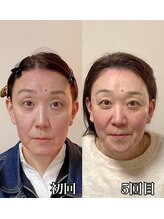 小顔22 ボルティ 赤坂支店(Bolty)/【悩み】面長・たるみ