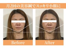 シーワイビー(C.Y.B)/美容鍼ビフォーアフター　CYB