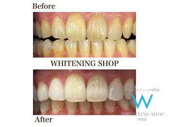 ホワイトニングショップ 甲賀店/Before&After『ホワイトニング』
