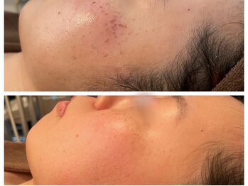 ヨリ(yori)/シミケア