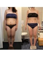 ニコリー(NICOLY)/キャビリポ痩身