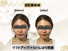 エモシオン トウキョウ(EMOTION TOKYO)/造形美容鍼