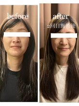 アイリー(Irie)/小顔矯正