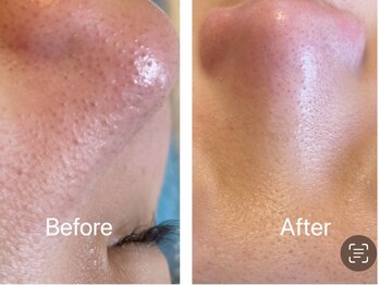 アベニール(AveniR)/毛穴エクストラクション