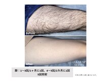 ナル(Nalu)の雰囲気（脱毛お客様施術例【5回施術】メンズのお客様も大歓迎！）