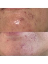 シェノン 赤坂大濠店/施術前→１週間後　