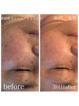 ステライチマルサン(stella.103)/眼精疲労リンパフェイシャル