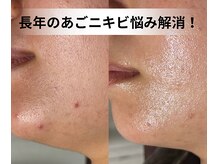 エステ リラクゼーションサロン(more)の雰囲気(事例多数のREVIハーブピーリングで自信の持てる素肌へ☆)