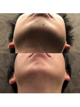 フェリーバ(FELIVA)/濃いお髭もお任せください！