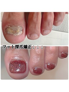 スマイルニコ(smile nico)/足の深爪矯正