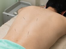 メディケア 川崎宮前治療室/鍼の施術
