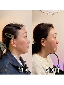 小顔22 ボルティ 赤坂支店(Bolty)/【悩み】面長・たるみ