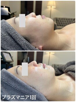 リッシュボーテ(RICHE BEAUTE)/プラズマピーリング/ビフォアフ