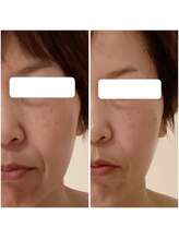 サロン リア(Salon Li’a)/☆小顔コース80分☆40代