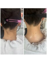 ルーラ(LURA)/痛みの少ない脱毛です