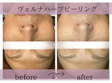 サロンドボーテアリス (Salon de beaute ALICE)/ヴェルナハーブピーリング