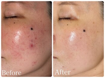 ロイヤル(ROYAL)/ニキビ/赤み改善症例