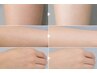【夏限定】脚・腕・手の甲 美肌フォト/毛穴・ポツポツ肌ケア　　￥6,000