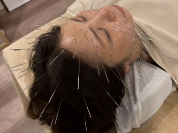 ツボミ(tubomi)の写真/芸能人も利用の鬼美容鍼◎顔の印象を変える！史上最高の小顔へ！