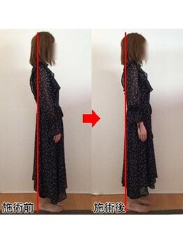 整体院プラス/猫背矯正モニター