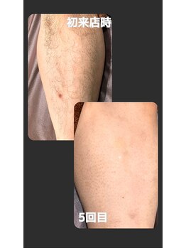 トゥルー(true)/足脱毛　経過写真