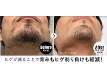 RBL 赤羽店/メンズ脱毛/ヒゲ脱毛2回目剃毛後
