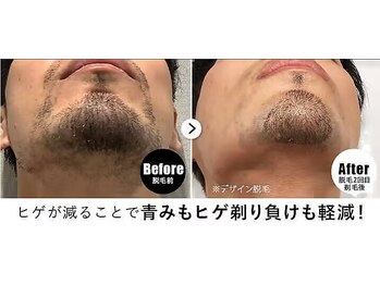 RBL 赤羽店/メンズ脱毛/ヒゲ脱毛2回目剃毛後