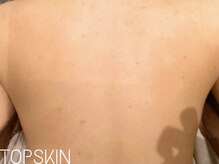 トップスキン 表参道(TOPSKIN)/肌質改善ハーブピーリング◎