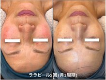 ユマニ バイ ヒート(Humani by HEAT)の雰囲気（大人気のFace wax、話題のララピールでお肌の悩み解決♪）