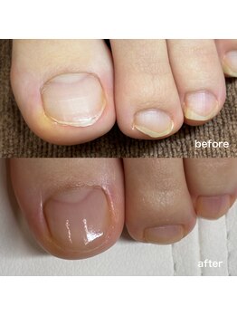リリ(lili)/フットネイルスキンケア1回目