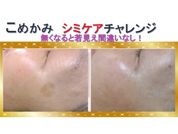 ビューティークリニーク アマーレ(Amare)/こめかみシミケアチャレンジ