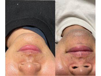 オアシス カナヤマ(Oasis kanayama)/【ヒゲ脱毛】