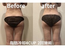 ユー 喜連西店(U)/脂肪冷却【before　after】