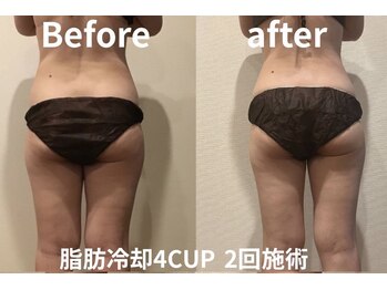 ユー 喜連西店(U)/脂肪冷却【before after】