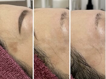 GRACETHOUSAND(グレイスサウザンド)/ハーブピーリング/洗浄/シミケア