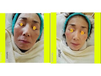 セントラル鍼灸院リラクシー(Re:laxy)/パルス美容鍼施術後驚き