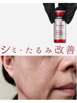 プレイス 太融寺店(PLACE)/redshot　理想の小顔へ