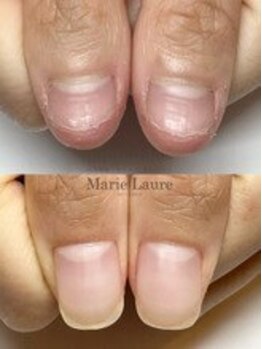 マリーロール 梅田店(Marie Laure)/自爪育成/深爪矯正/ネイルケア