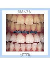 ホワイトニングショップ 芦屋店/お客様のビフォーアフター♪