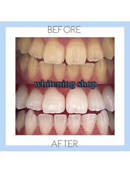 ホワイトニングショップ 芦屋店/お客様のビフォーアフター♪