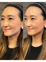 長寿鍼灸院 長寿整骨院/ハリネズミ女優美容鍼効果★