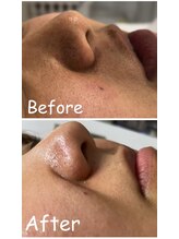 ギャラクシービューティー(galaxy beauty)/WAXと光のダブル脱毛